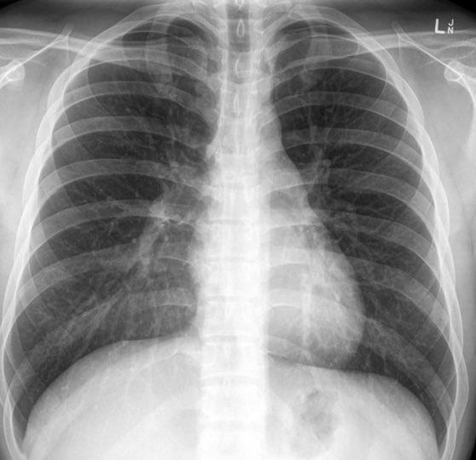 So sieht die Lunge eines geimpften Covid-19-Patienten aus.