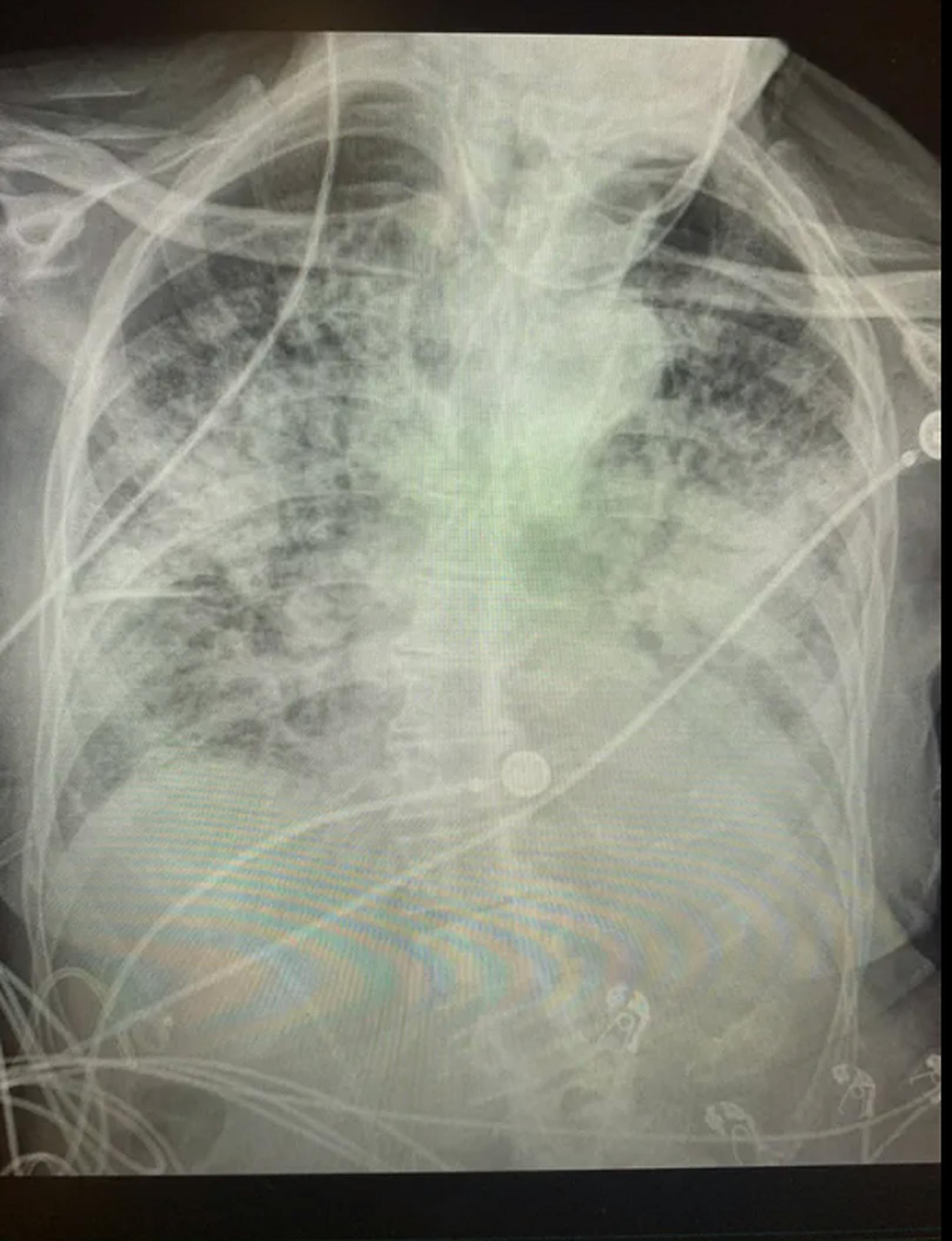 So sieht eine Lunge nach einer schweren Covid-Erkrankung aus.