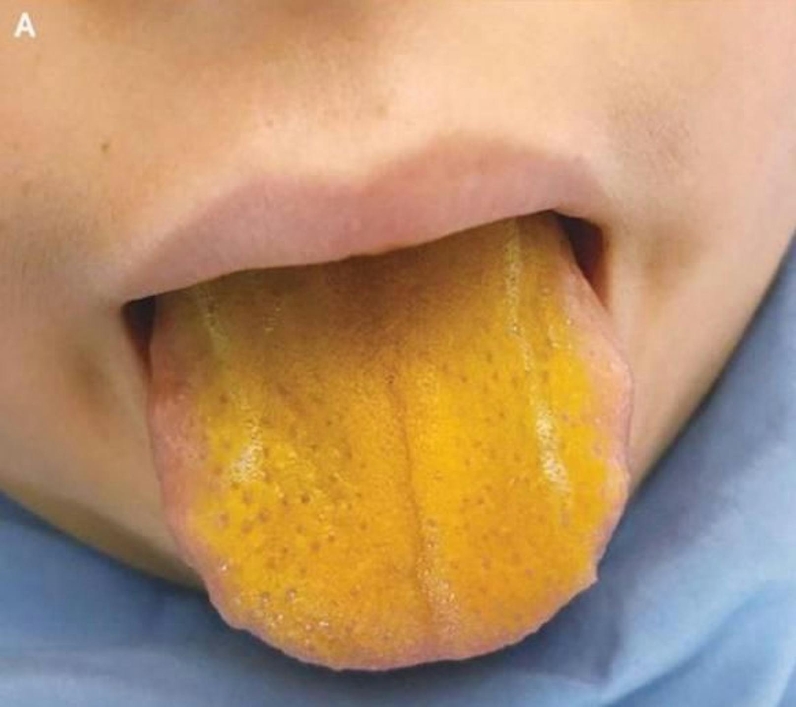 In Kanada wurde ein 12-Jähriger mit einer gelben Zunge im Spital vorstellig. 