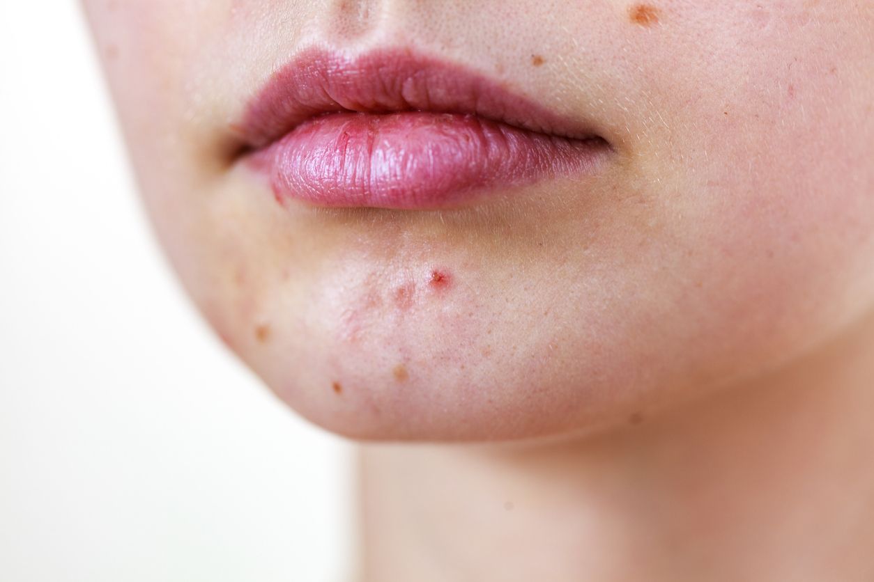 Young woman showing her face with acne and moles, dry lips. Teen girl no make up with red spots on her chin. Health problem, skin diseases.