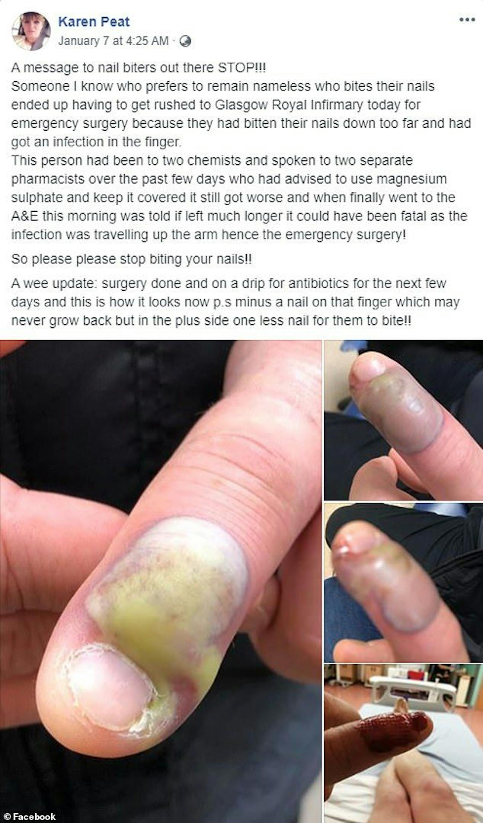 "Jemand, den ich kenne, der es vorzieht, namenlos zu bleiben, der sich in die Nägel beißt, musste heute zur Notoperation in die Glasgow Royal Infirmary eingeliefert werden, weil er sich zu weit in die Nägel gebissen hatte und eine Infektion im Finger hatte", schrieb Peat in ihrem Posting.