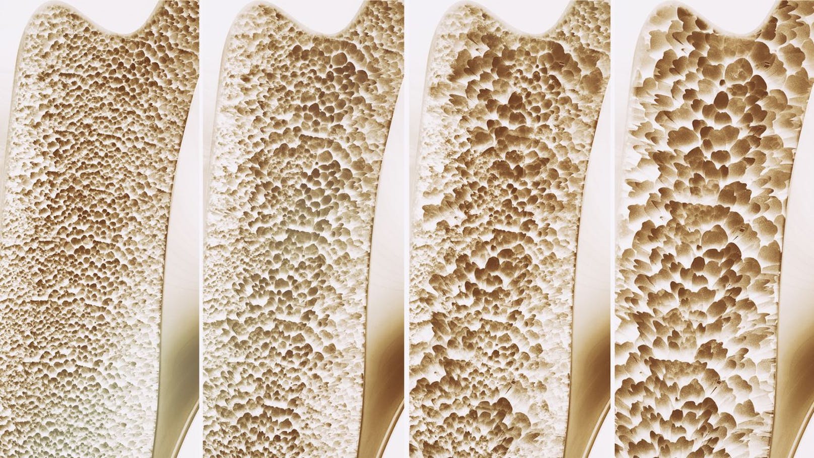 Bei Osteoporose verliert der Knochen an Masse und Festigkeit. Dadurch bricht er leichter.