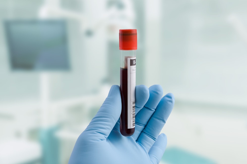 Long Covid soll mittels Biomarker im Blut von Genesenen nachweisbar sein.