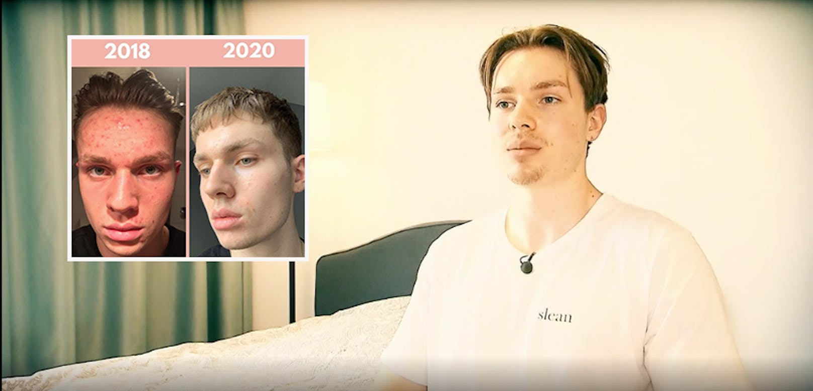 Durch seine Akne wurde der 21-jährige Alex zum "Skinfluencer".