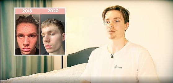 Durch seine Akne wurde der 21-jährige Alex zum "Skinfluencer".