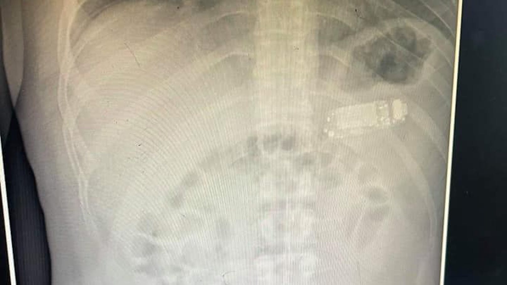 Die Ärzte in Pristina staunten nicht schlecht, was sie auf dem Röntgenbild sahen: Der Mann hatte ein Handy verschluckt!
