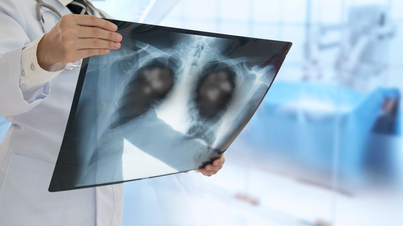 Doctor looking Pneumonia patient x-ray film for diagnose  Emphysema,Pneumonia,Inflamed lung.