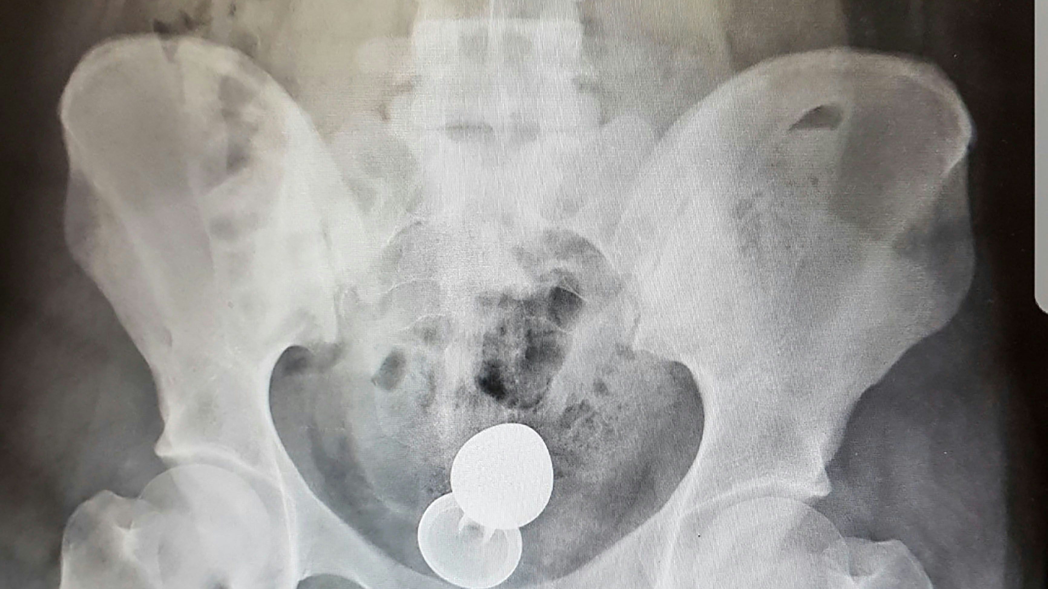 Heute.at - Sexspielzeug blieb in Darm stecken – OP!