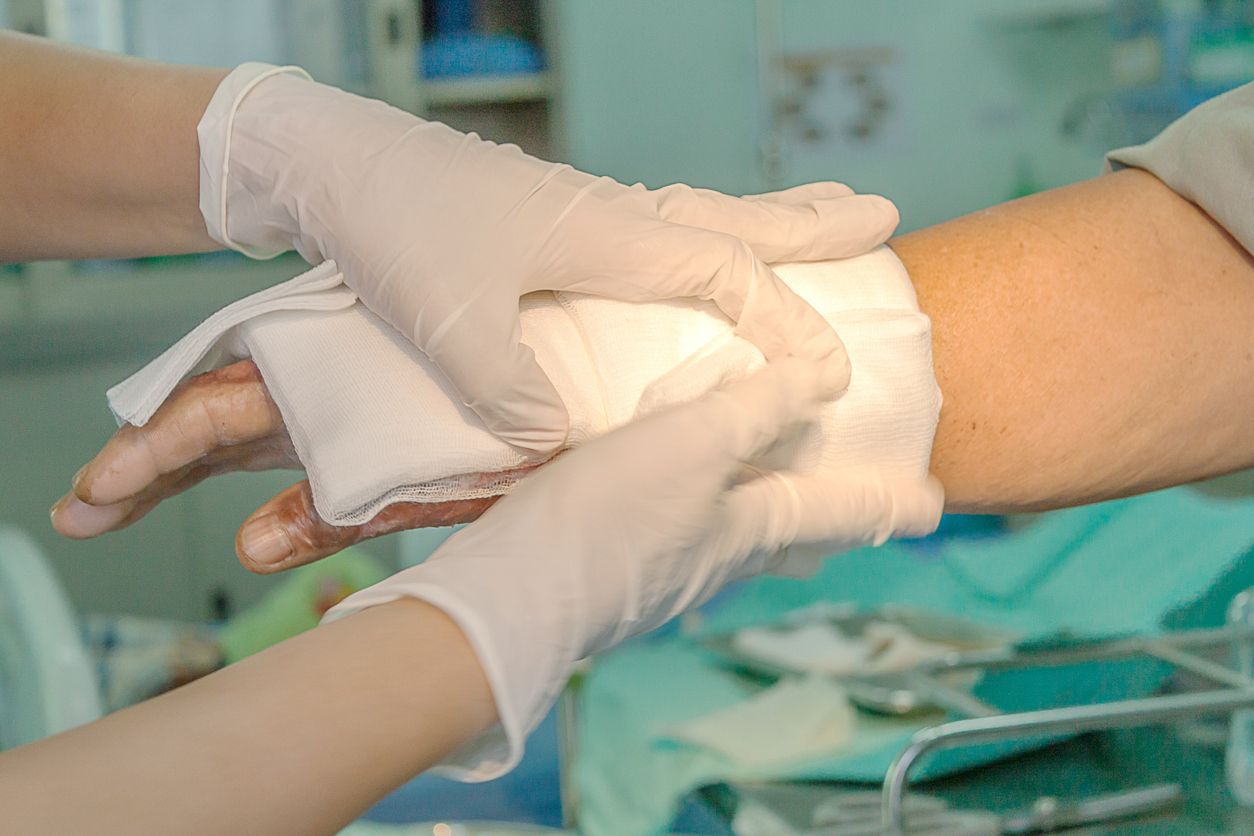 Dressing burned wound hand with gauze pad