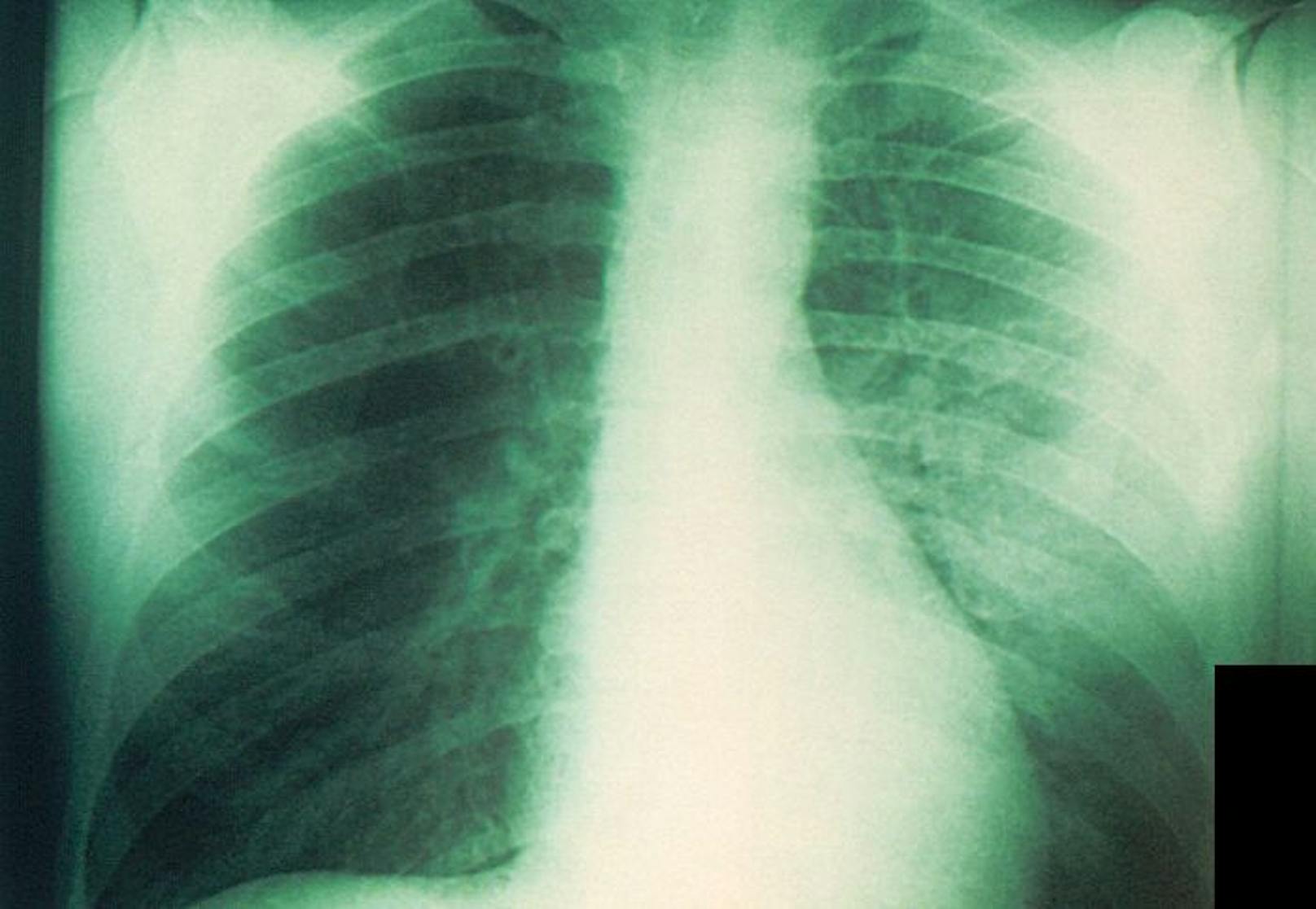 Röntgenbild einer mit Pest infizierten Lunge. (Symbolbild)