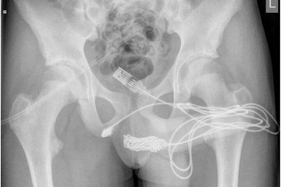 Das Röntgenbild zeigt den Verlauf des USB-Kabels in der Harnröhre des Teenagers.