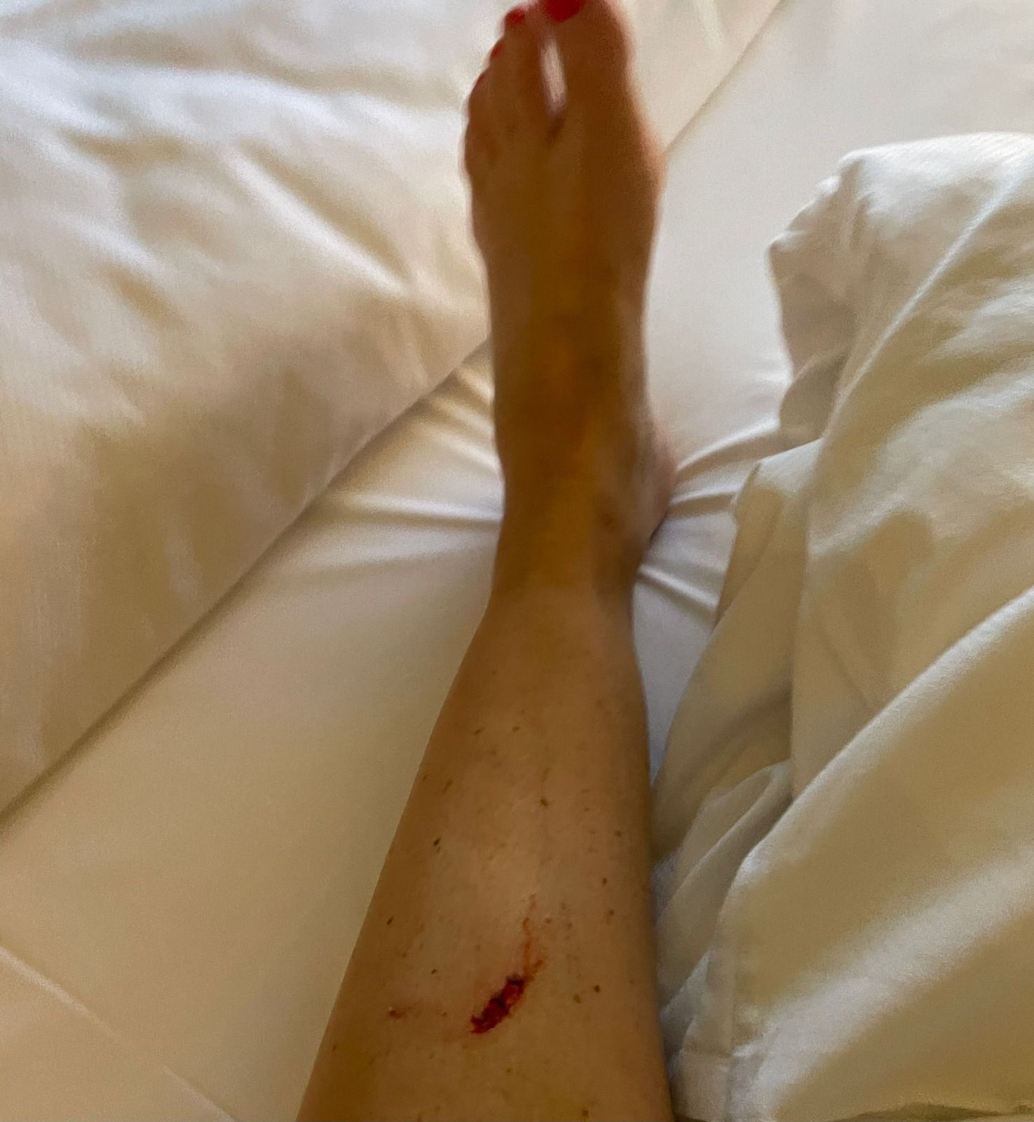 Nina Kraft stürzte schwer und verletzte sich am Schienbein. 