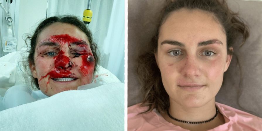 Alice Merryweather direkt nach ihrem schweren Sturz und drei Wochen nach der Gesichtsverletzung.