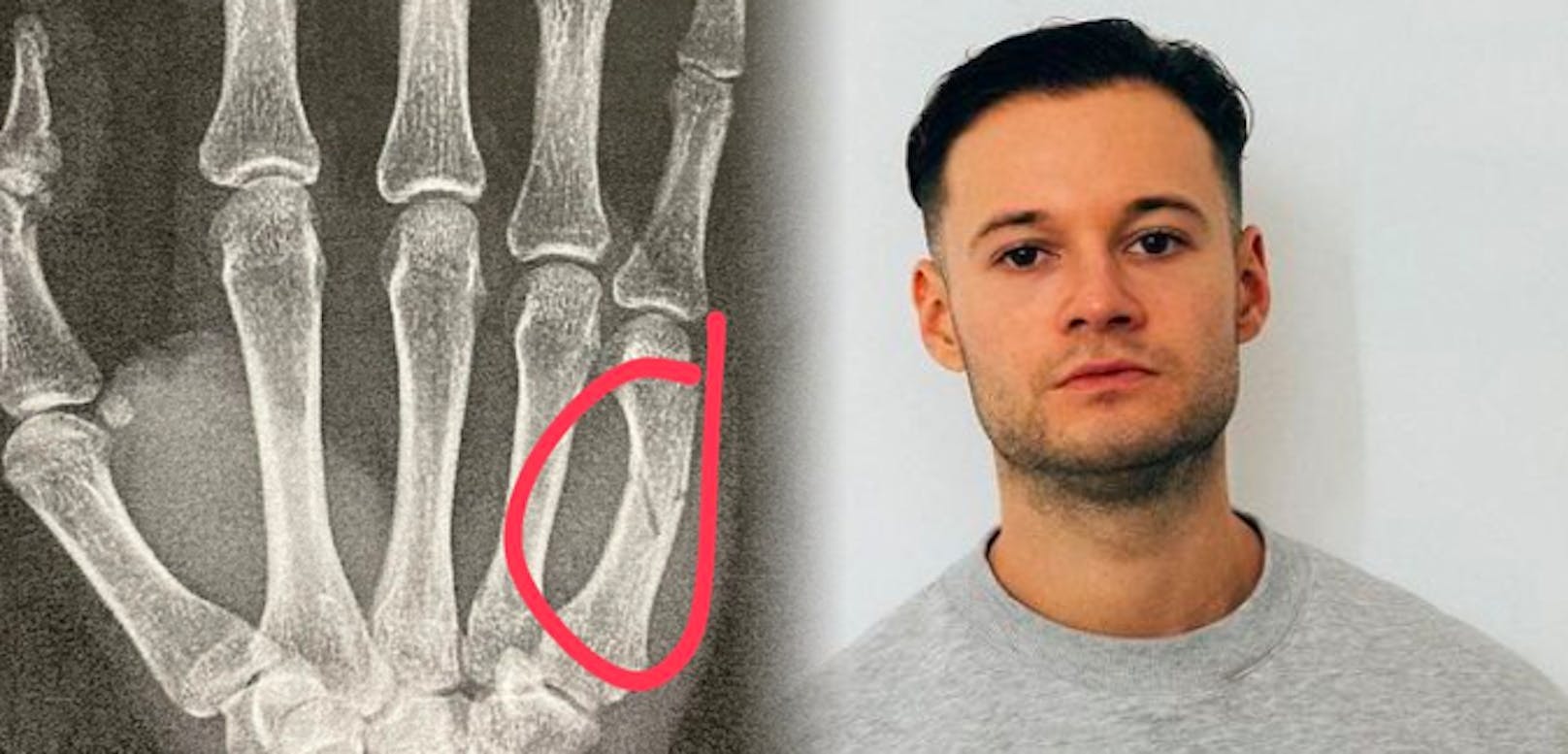 Youtuber inscope 21 neben dem Röntgenbild seiner gebrochenen Hand.