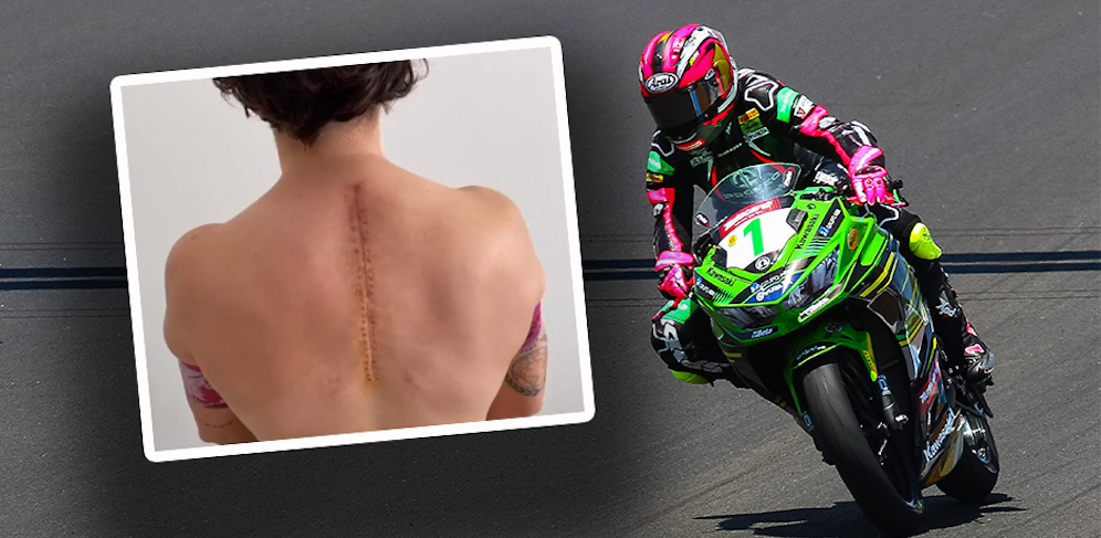 Ana Carrasco zeigt ihre OP-Narbe. 