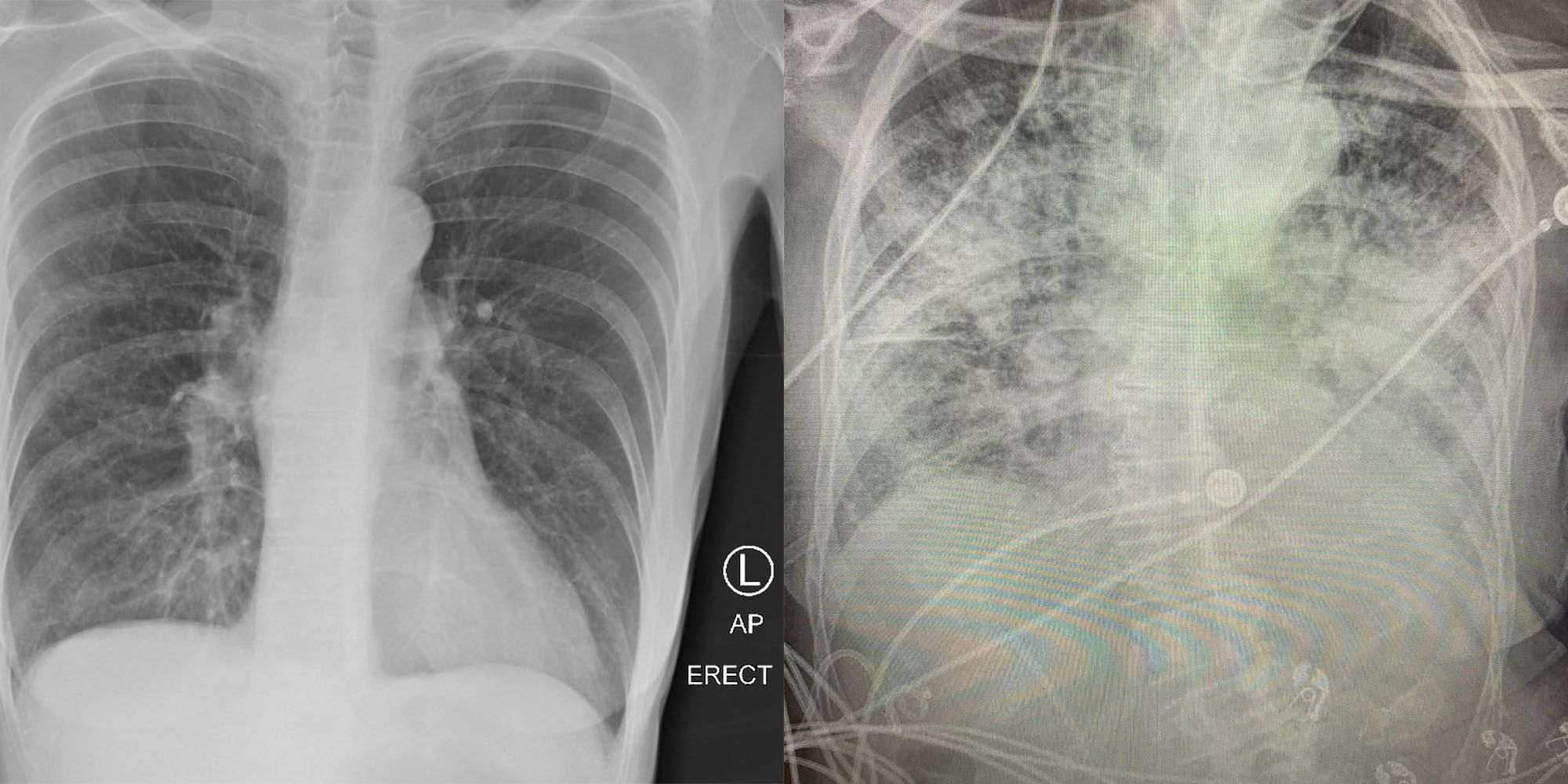 Links eine Raucher-Lunge, rechts die Lunge eines Covid-Erkrankten