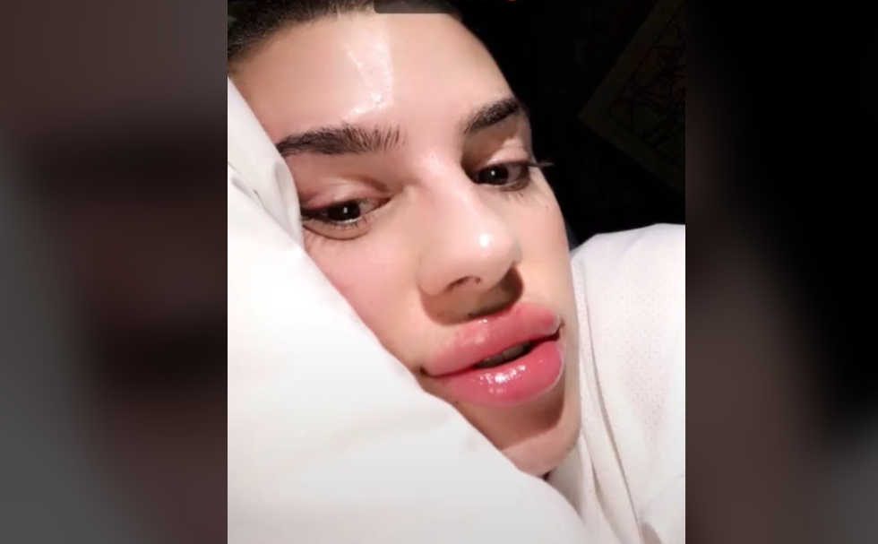  TikTokerInnen zeigen, wie der Moderna-Impfstoff bei Menschen mit Lippenfüllern & Co. zu Schwellungen führen kann. 