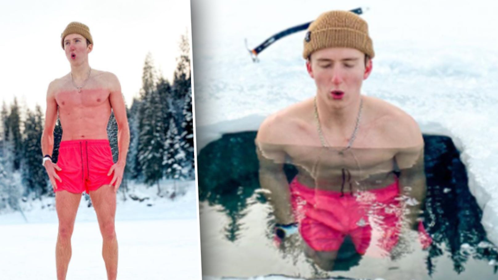 Ski-Star zeigt brutalen "Sonnenbrand" nach Eisbad