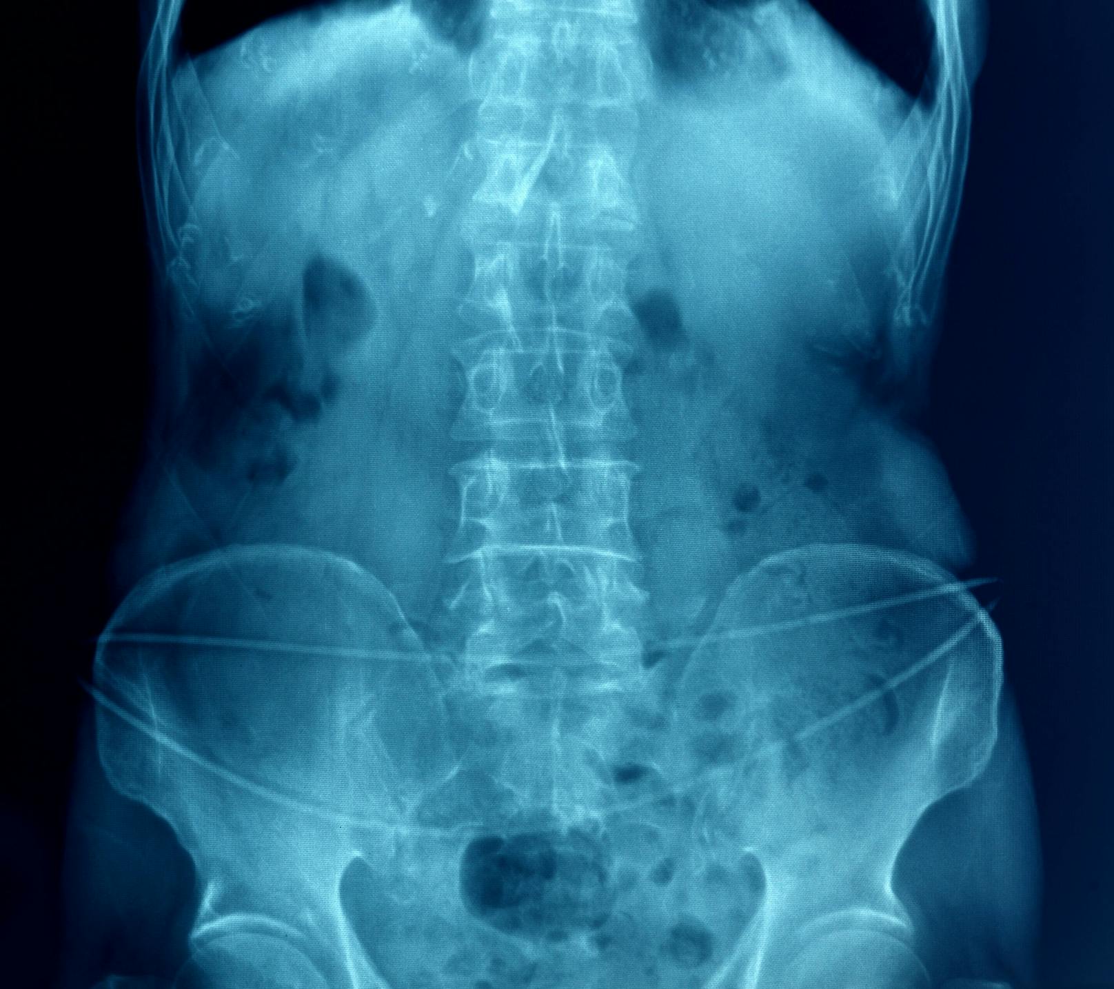 Ärzte röntgen Mann – und glauben nicht, was sie finden