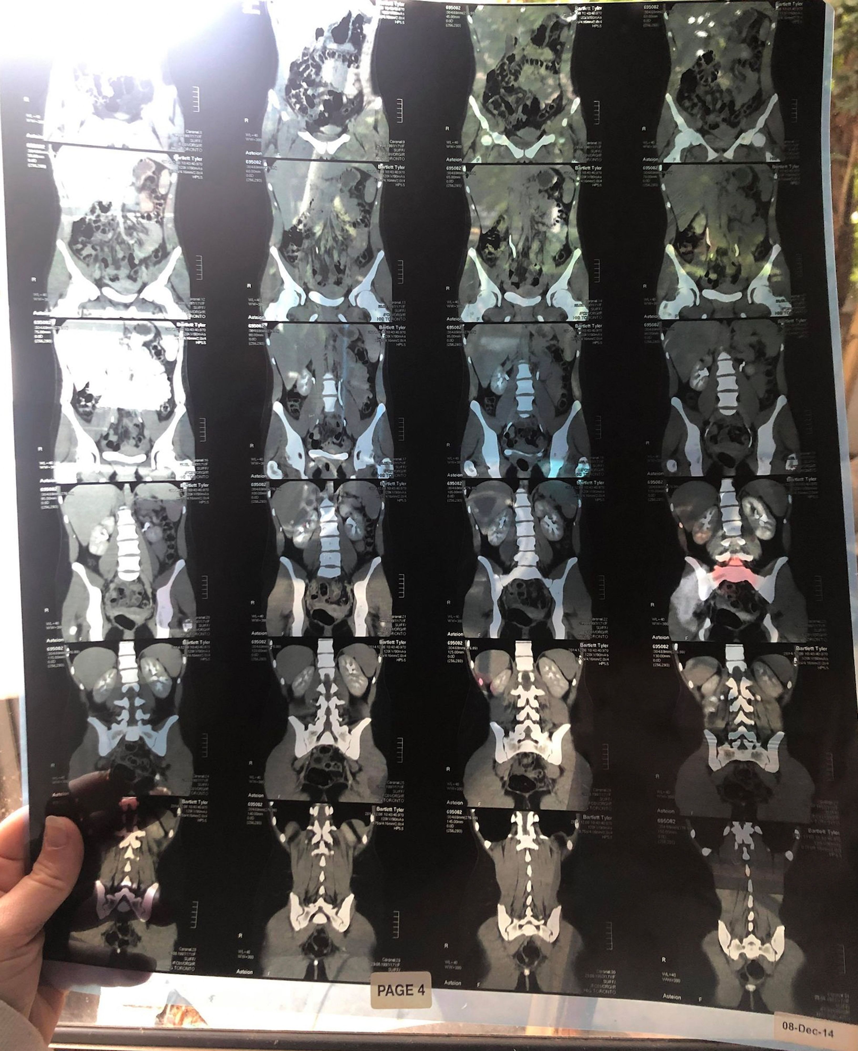 Die Diagnose: Vaginalseptum.&nbsp;