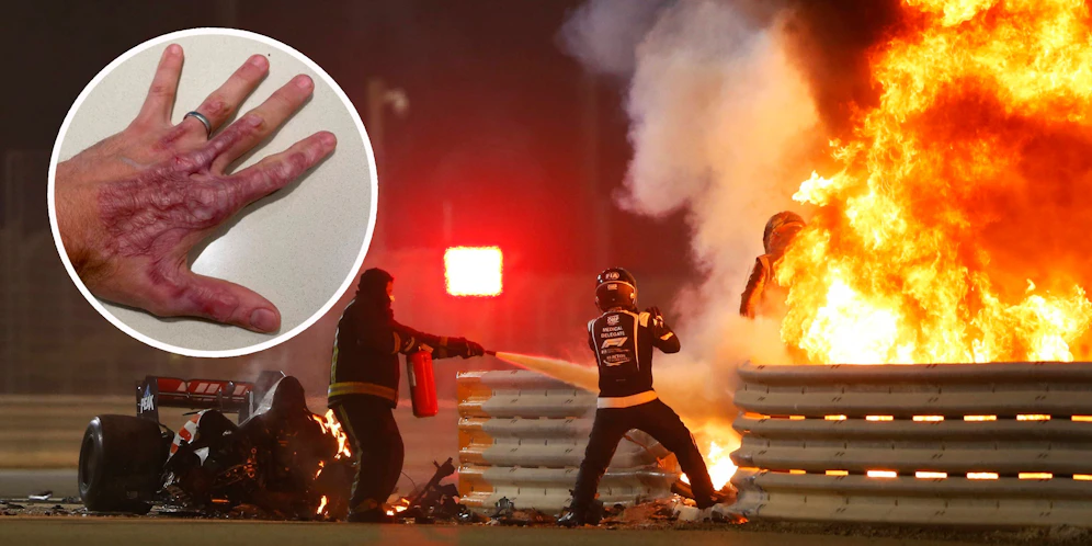Romain Grosjean leidet immer noch an den Spätfolgen seines Feuer-Crashs.
