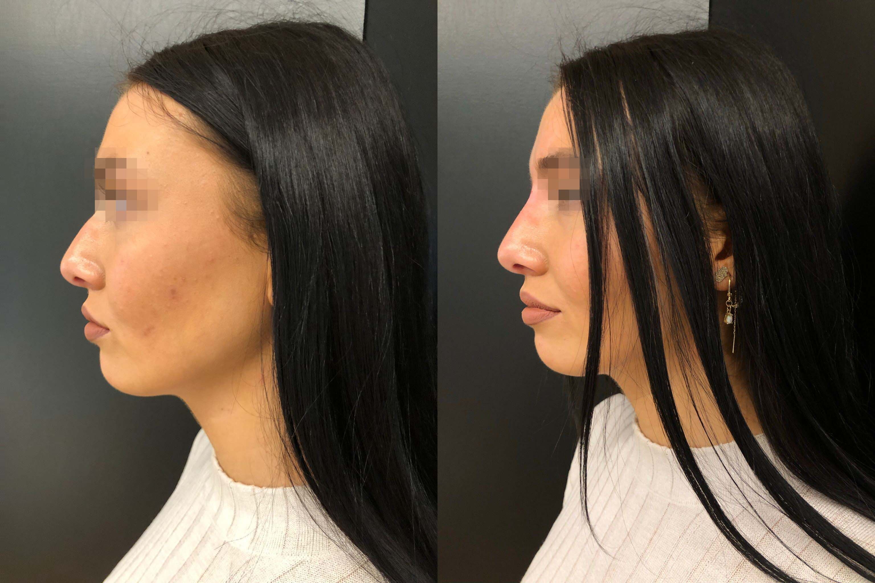 Sarah H. missfiel ein kleiner Höcker (li.) auf ihrer Nase. Sie ließ ihn mittels "Liquid Rhinoplasty" ohne Skalpell korrigieren (re.). 