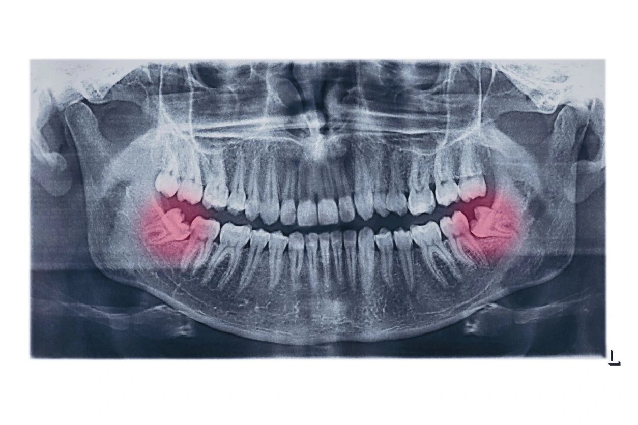 different types of wisdom teeth problems concept. Problem teeth X-ray image scanned