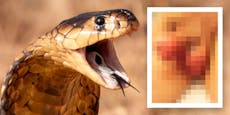 Schlangen-Biss am Klo – plötzlich wurde Penis schwarz