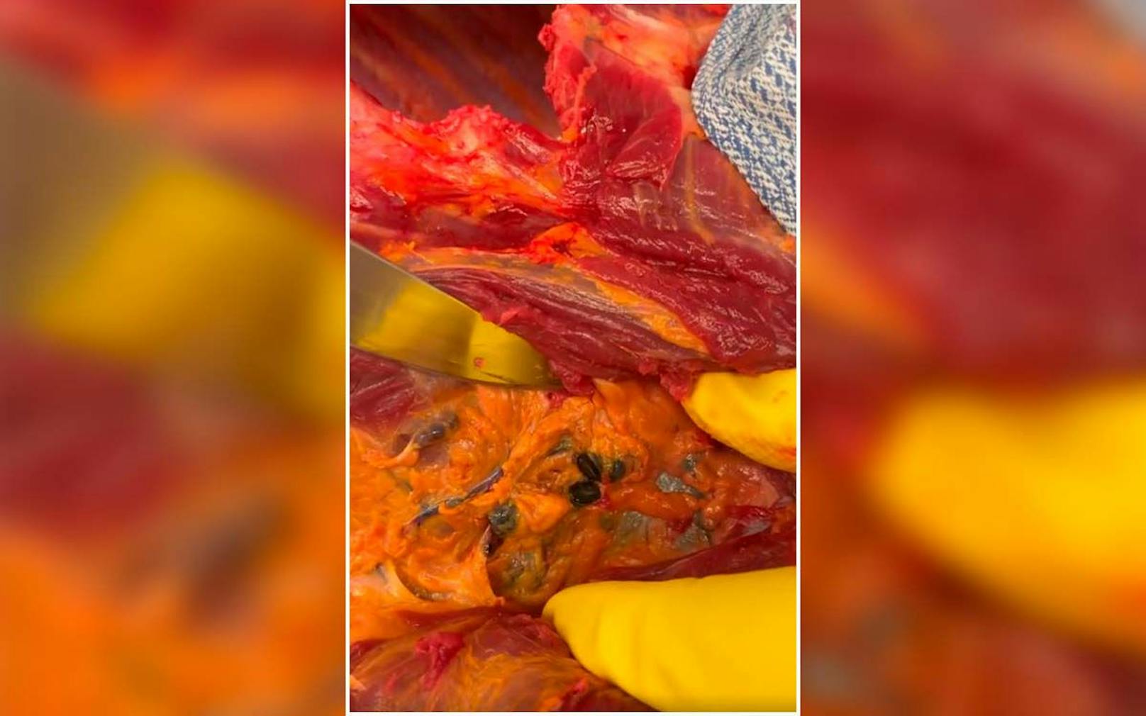 Das Bild zeigt die von der Tattofarbe geschwärzten Lymphknoten in der Achsel einer großflächig tätowierten Verstorbenen.&nbsp;