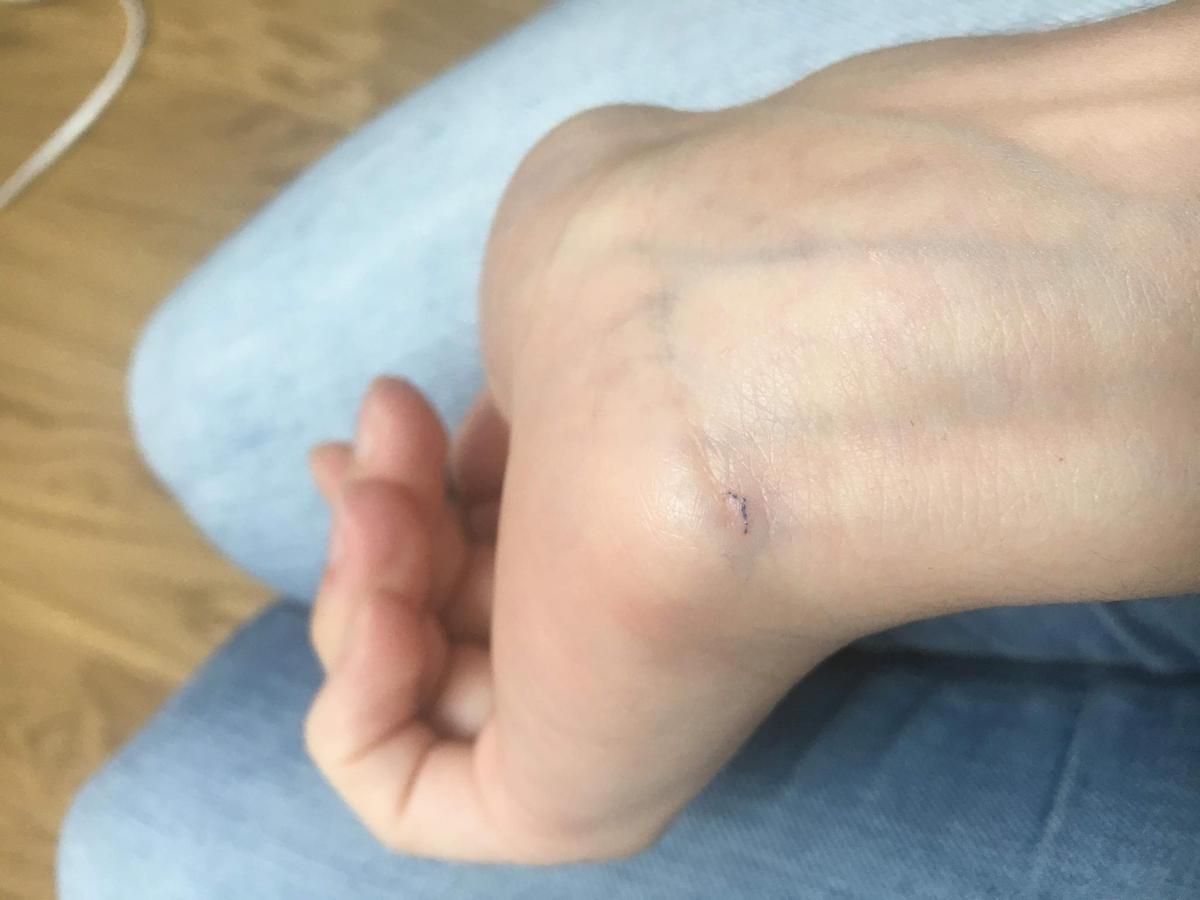 Die Milben hinterlassen in der Haut kleine Fressgänge.