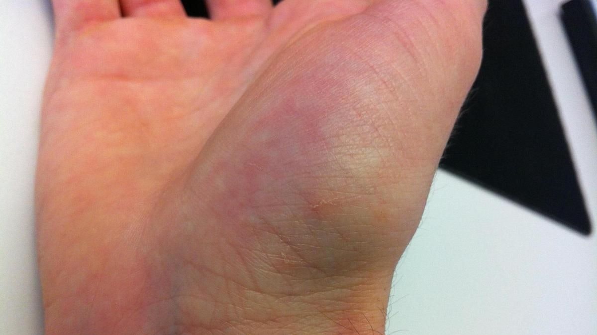 Dutzende Leser*innen haben von ihren Erfahrungen mit der Hautkrankheit Krätze berichtet.