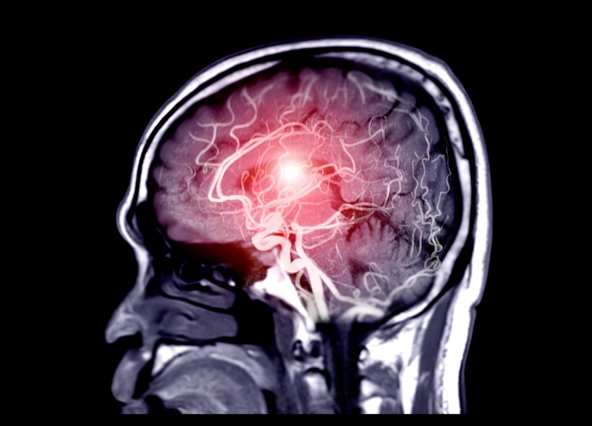 Fusion image of MRI and MRA Brain or Magnetic resonance angiography ( MRA )  of cerebral artery in the brain Sagittal view for evaluate them  stenosis  and stroke disease.
