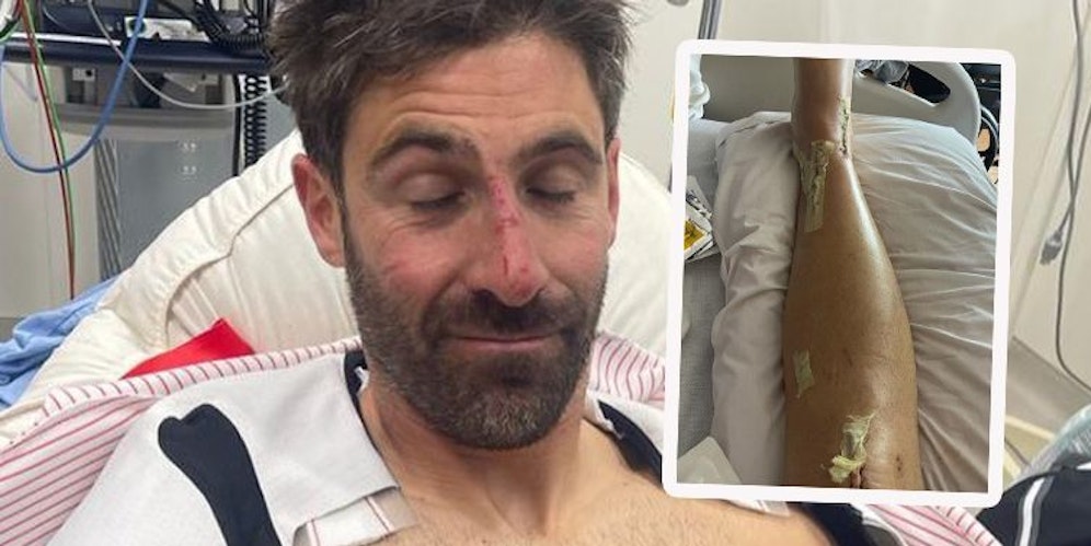 Adrien Theaux zeigt seine Narben.