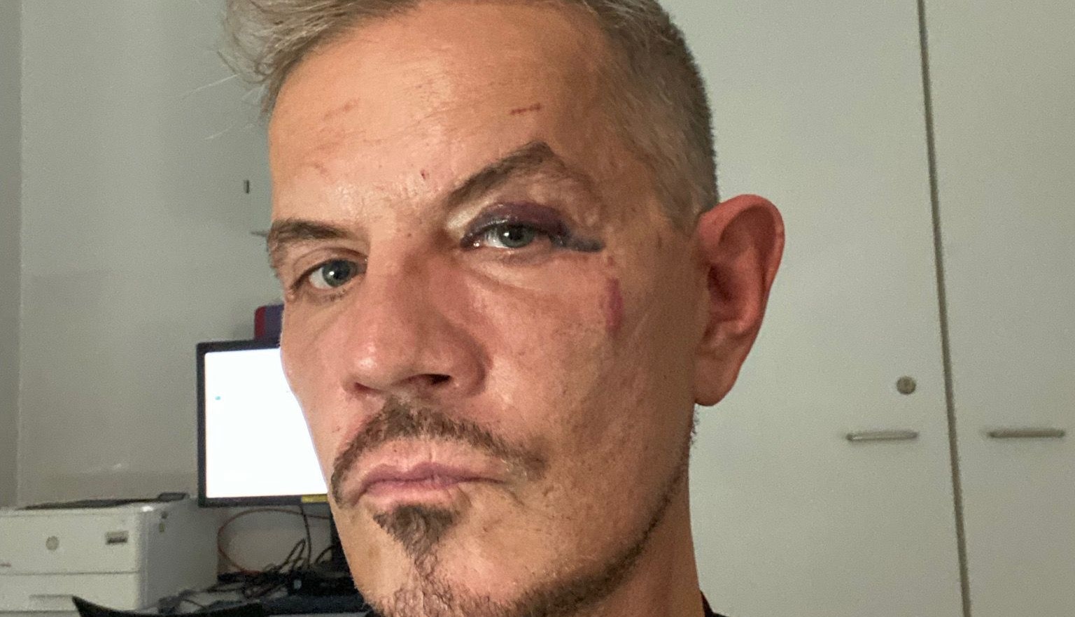 Dirk Heidemann zeigt seine Blessuren