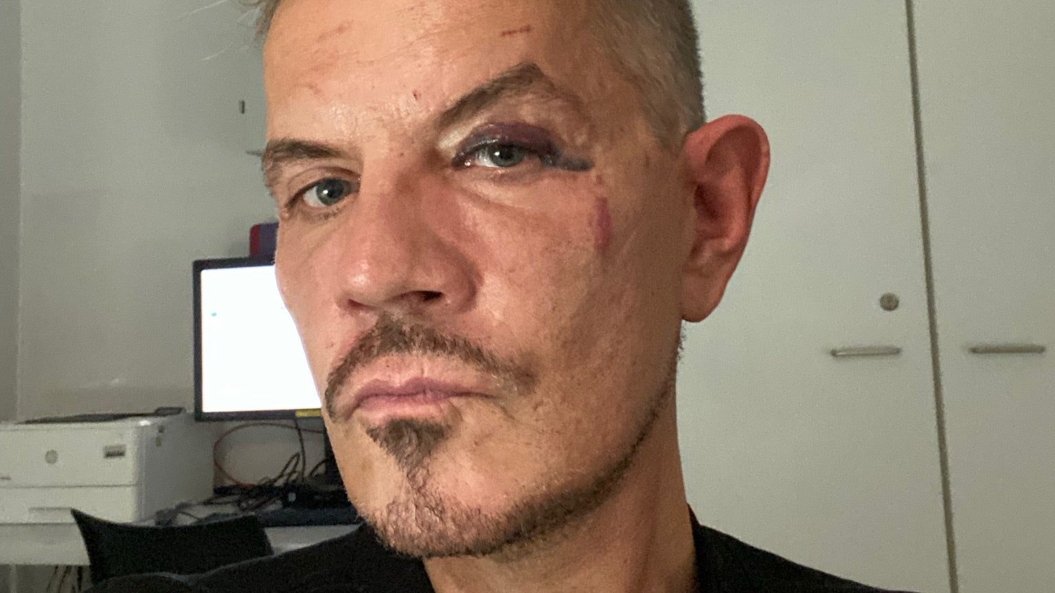 Dirk Heidemann zeigt seine Blessuren