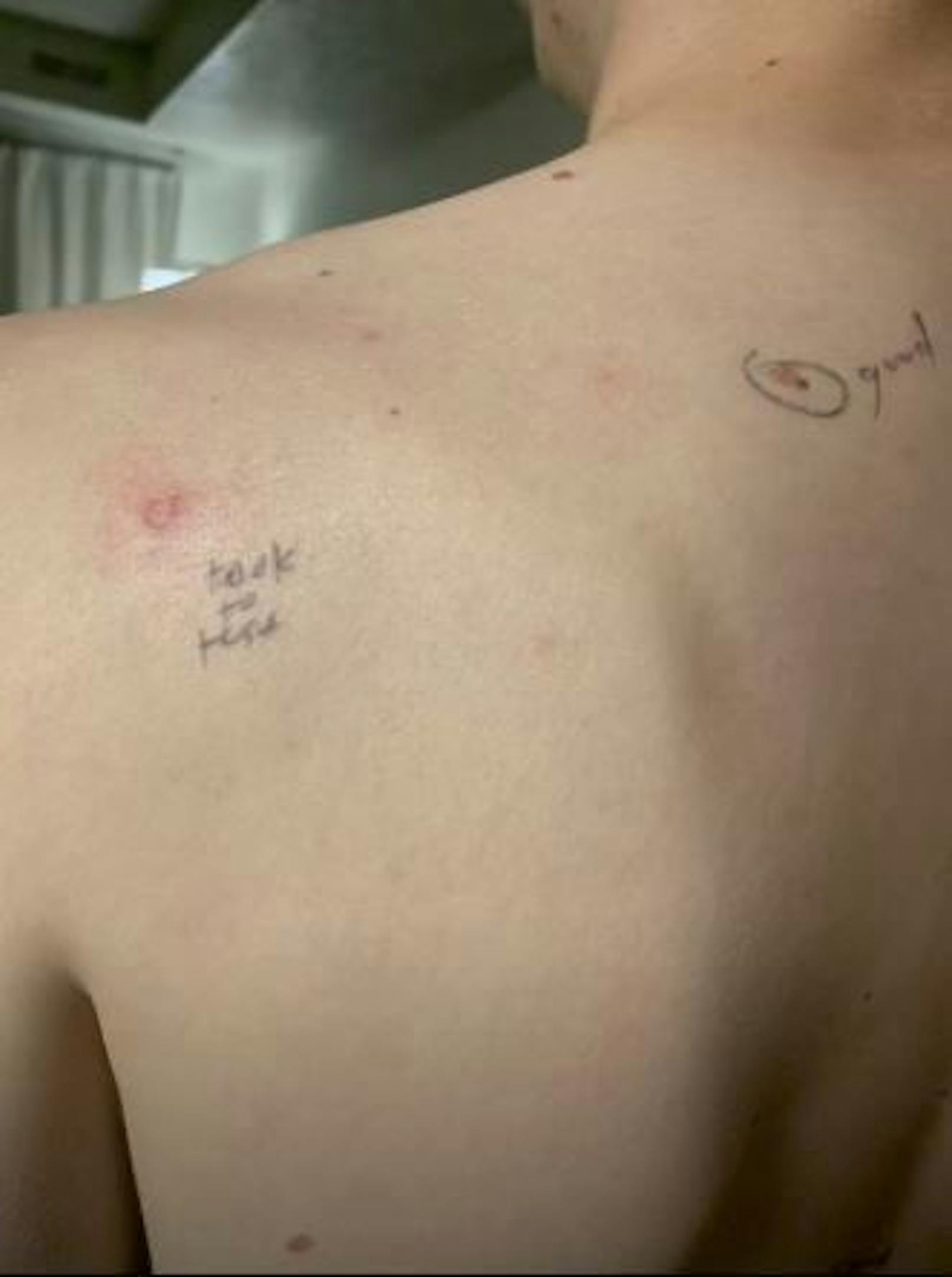 "Took to test": An der Schulter und auf der Brust entnahm der Arzt Gewebeproben, um sie auf Krebs zu untersuchen.