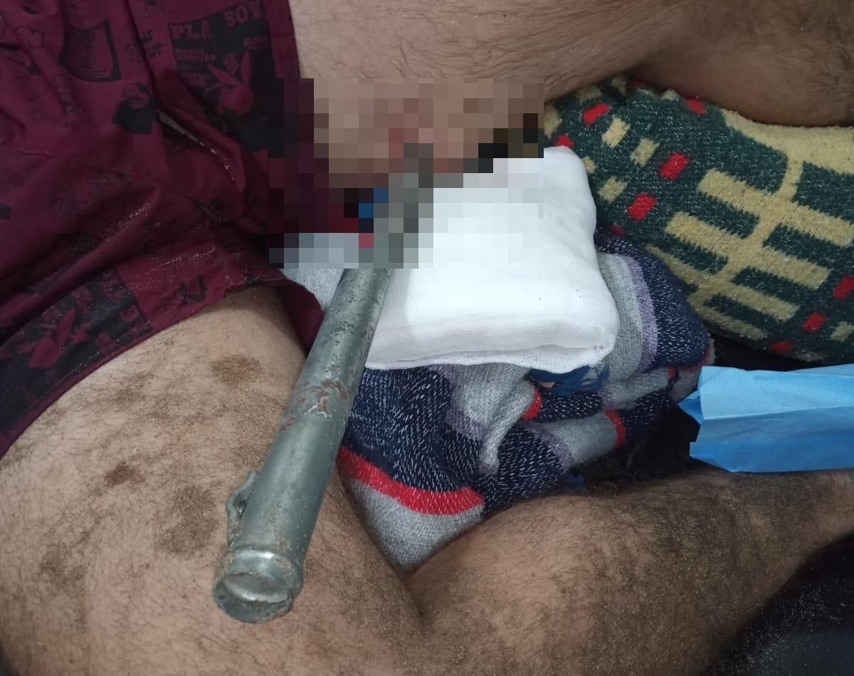 Ignacio Mascarenhas musste stillhalten, als die Feuerwehr die Eisenstange in seinem Bein mit einer Kreissäge durchtrennte.