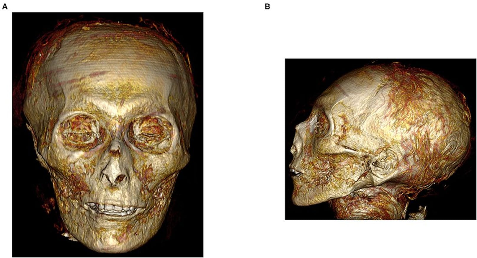 Dreidimensionales CT-Bild des digital entpackten Gesichts der Mumie Amenhotep I. <strong>(A)</strong> Dreidimensionales CT-Bild der Vorderseite des Gesichts von Amenhotep I und <strong>(B)</strong> Dreidimensionales CT-Bild des linken Profils des Gesichts von Amenhotep I. zeigt ein ovales Gesicht mit schmalem Kinn, kleiner schmaler Nase, die durch die Bandagen abgeflacht ist, leicht hervortretenden oberen Zähnen, eingefallenen Augen, eingefallenen Wangen, durchbohrtem Ohrläppchen und wenigen zusammengerollten Haarlocken.