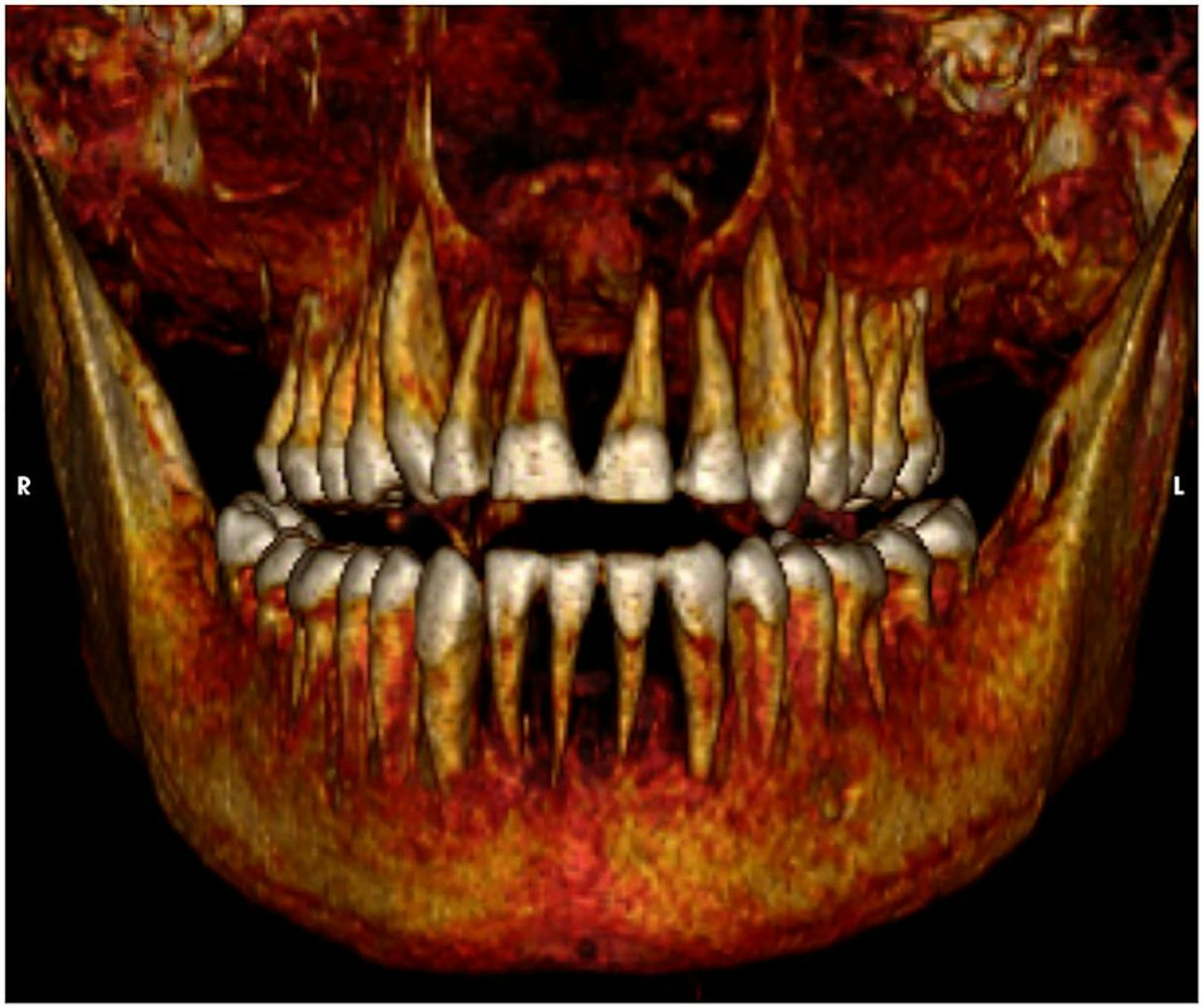 Die dreidimensionale CT-Aufnahme der Zähne von Amenhotep I in Frontalansicht zeigt ein vollständiges gesundes Gebiss.