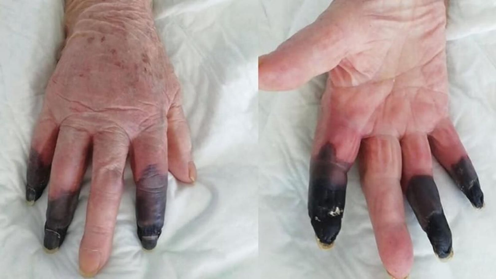 Ärzte müssen Italienerin (86) drei "Covid-Finger" amputieren.