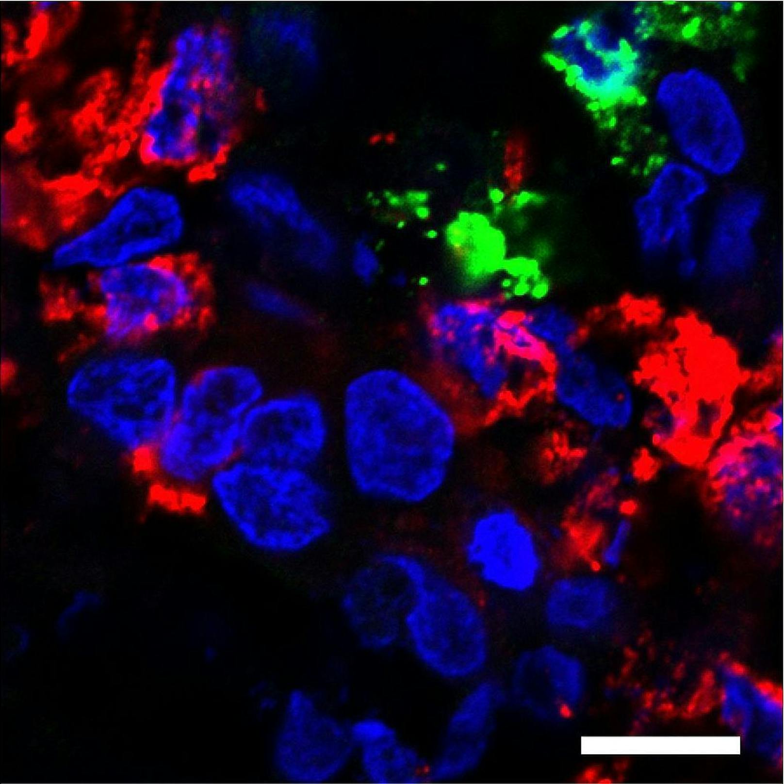 Fluoreszenzmikroskopische Aufnahmen von SARS-CoV-2-infizierten Beta-Zellen aus den Langerhans'schen Inseln des Pankreas 