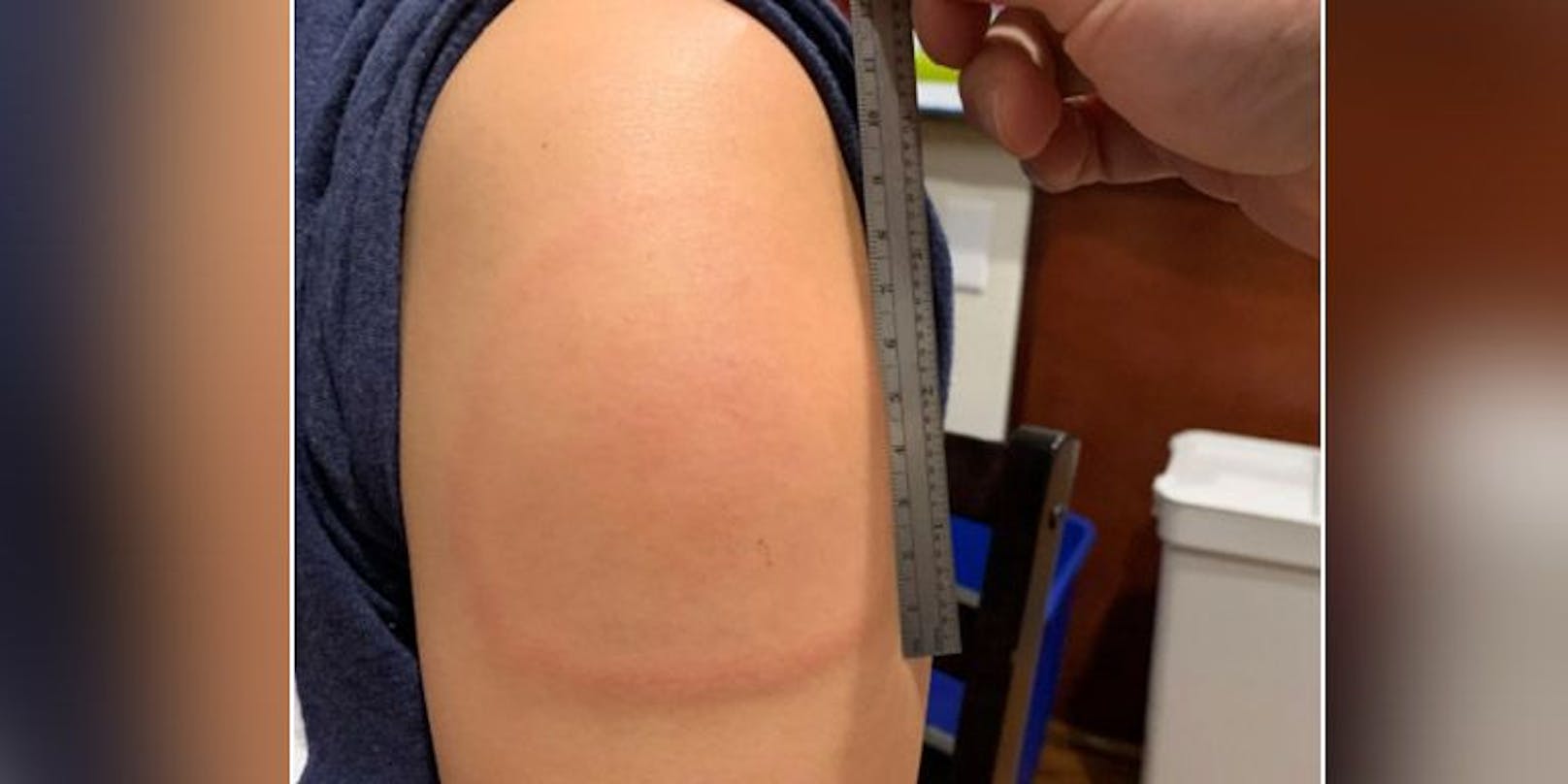 Ein "Corona-Arm" nach einer Impfung.