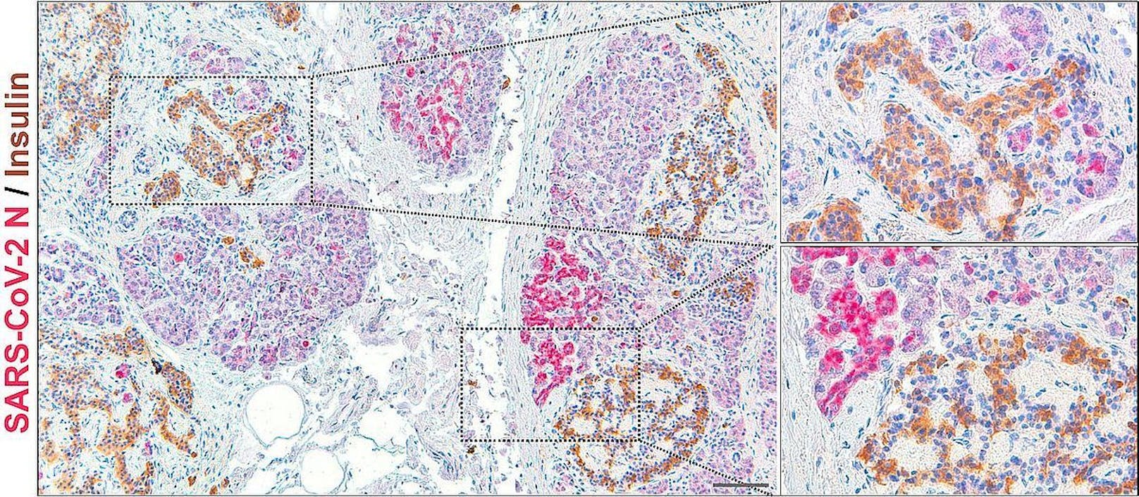 Gewebeschnitt aus dem Pankreas eines COVID-19 Verstorbenen: Zu sehen ist also, dass bei diesem Patienten die Langerhans'schen-Inseln (Insulin in braun eingefärbt) mit SARS-CoV-2 (pink) infiziert sind