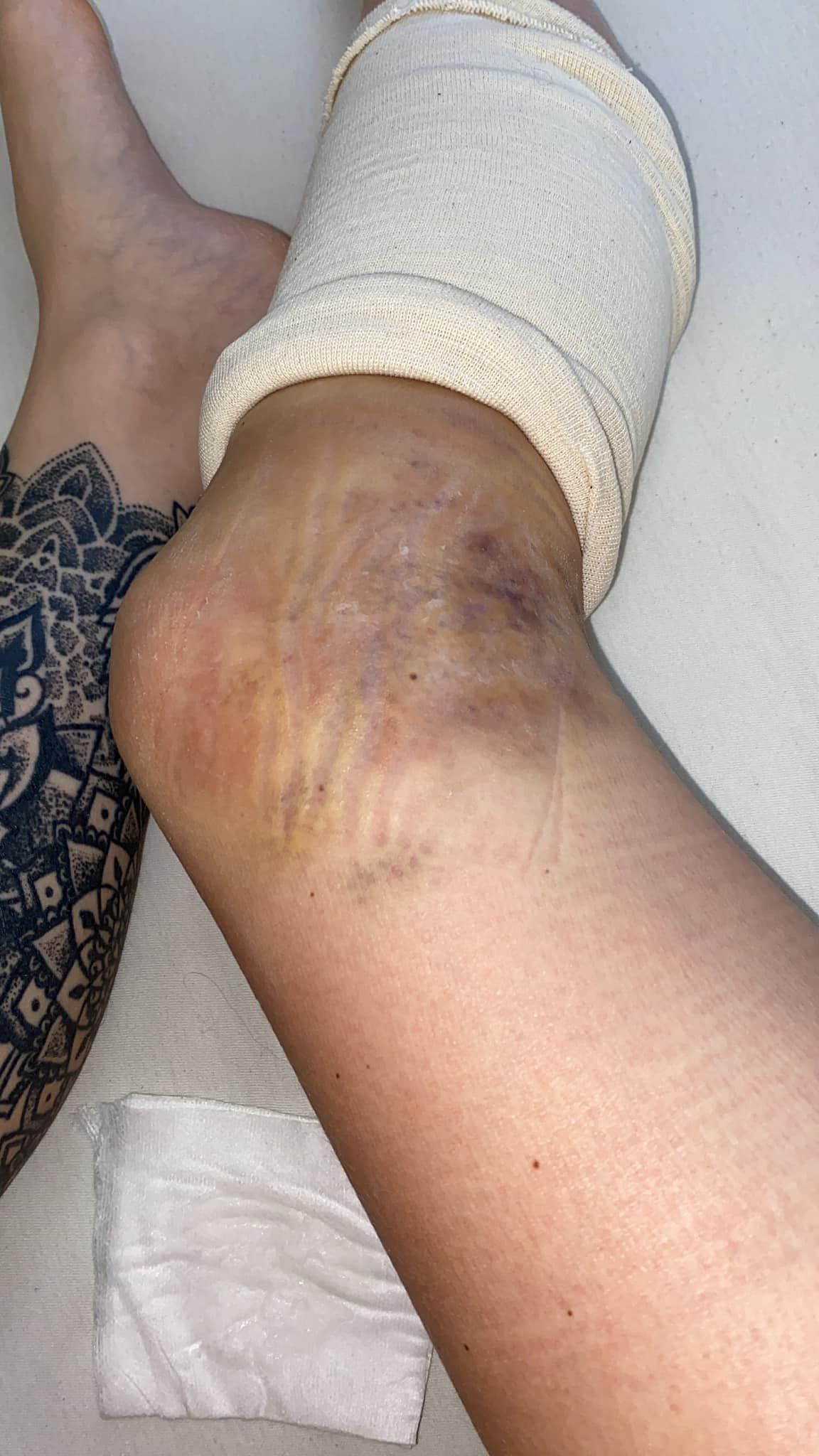 Michelle St. zeigt ihre schwere Verletzung am Bein.