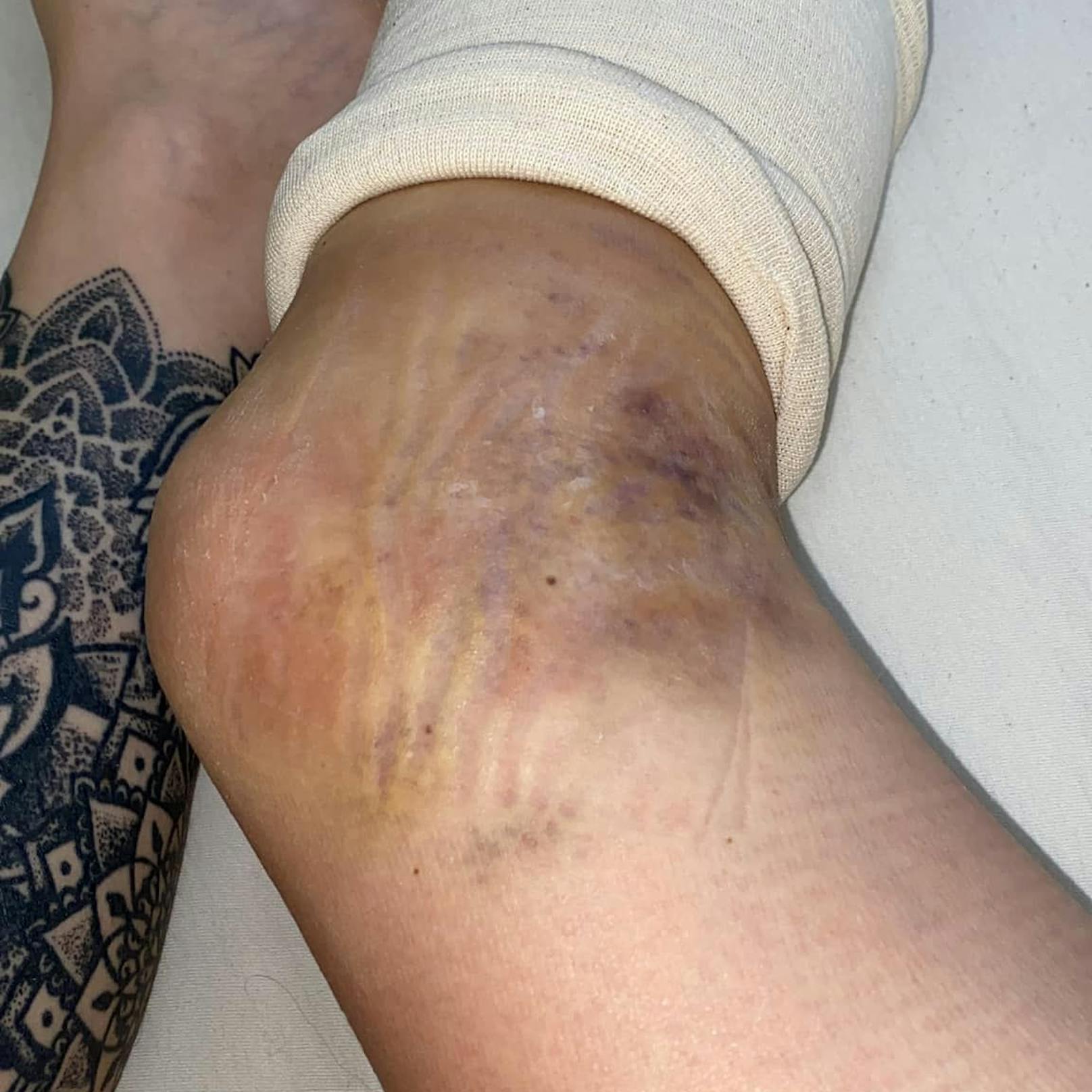 Michelle St. zeigt ihre schwere Verletzung am Bein.