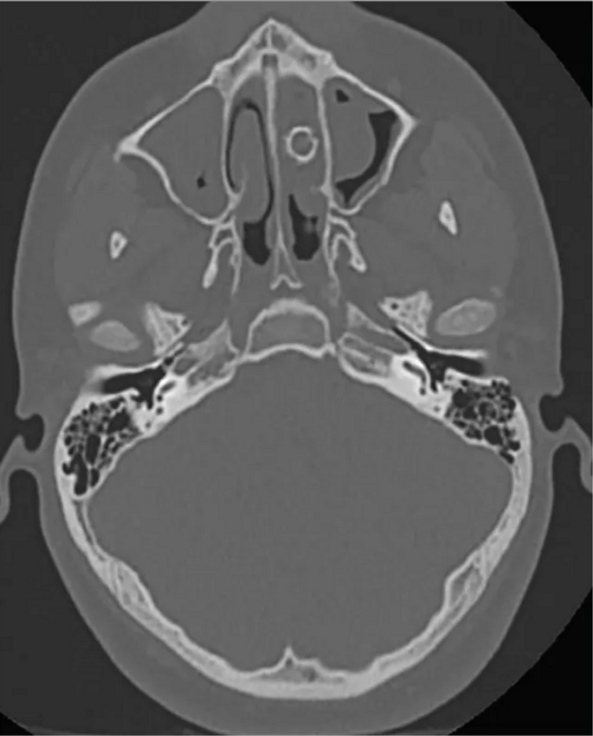 Ein bei einem weiteren Arzttermin angefertigter CT-Scan offenbarte, was die Ursache für die Probleme des zu dem Zeitpunkt 16-Jährigen herrührten.