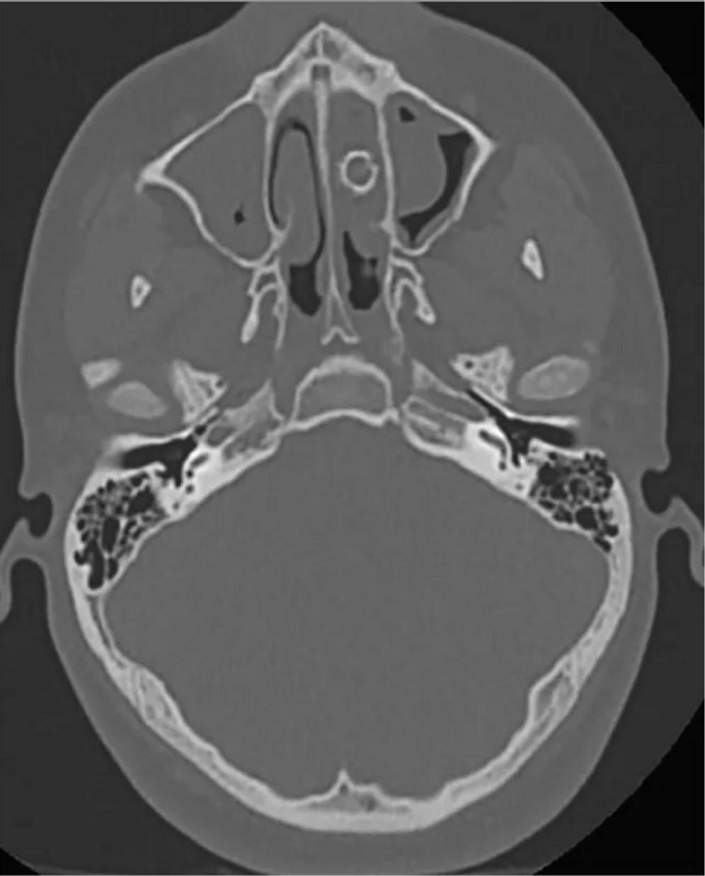 Ein bei einem weiteren Arzttermin angefertigter CT-Scan offenbarte, was die Ursache für die Probleme des zu dem Zeitpunkt 16-Jährigen herrührten.
