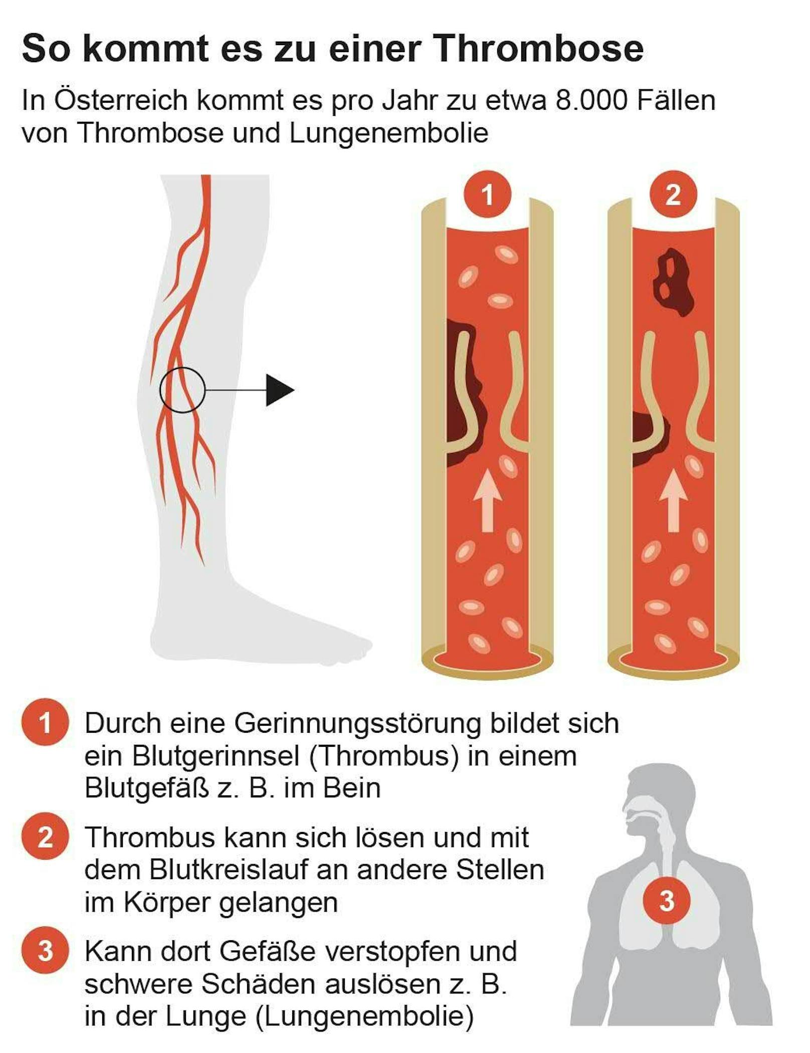 Schematische Darstellung eines Blutgerinnsels (Thrombus)