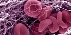 AstraZeneca: Forscher finden mögliche Thrombose-Ursache