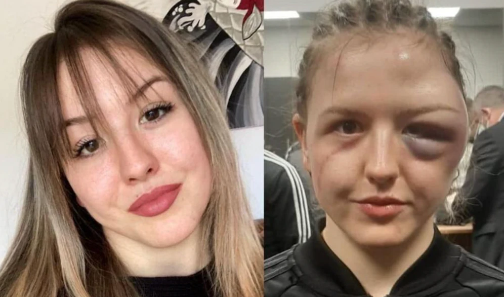Boxerin Cheyenne Hanson vor und nach dem Kampf.
